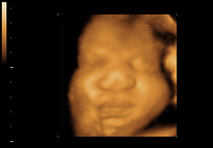 3D ultrasound image at 34 weeks